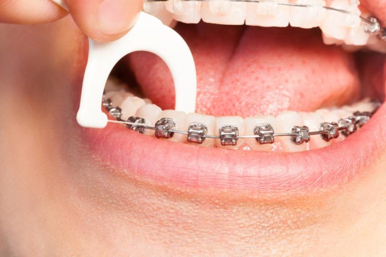Orthodontic Appliances Quast Orthodontics